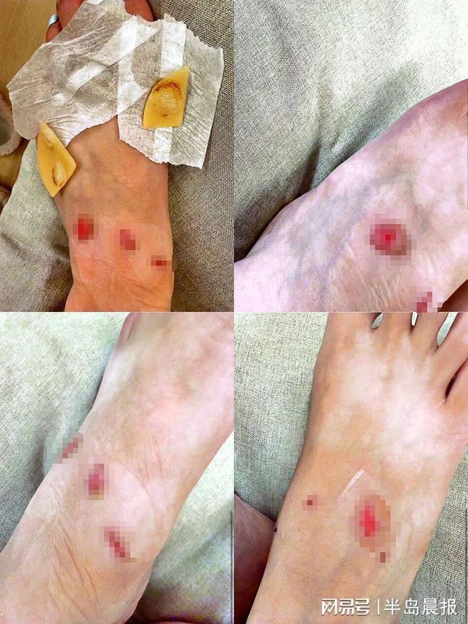 九游体育：女子购近万元LV运动鞋仅穿10分钟双脚破皮留疤！客服：不能退(图4)